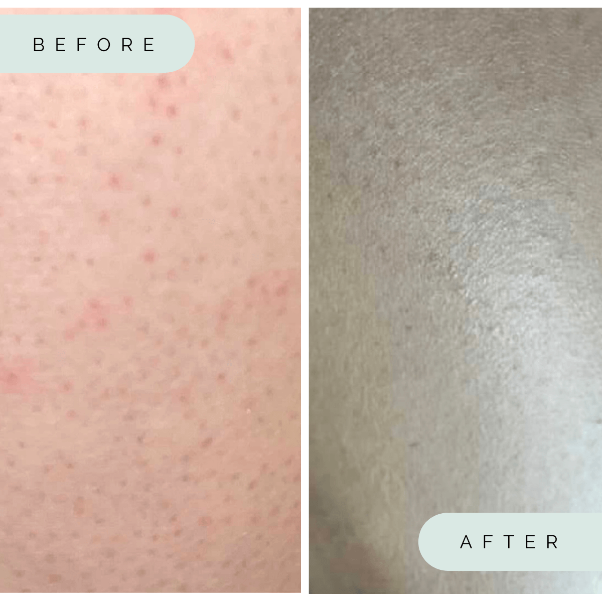 Wildpier Exfoliating Glove Before and after comparison of skin texture with 'Before' showing blemishes and 'After' showing smoother skin.